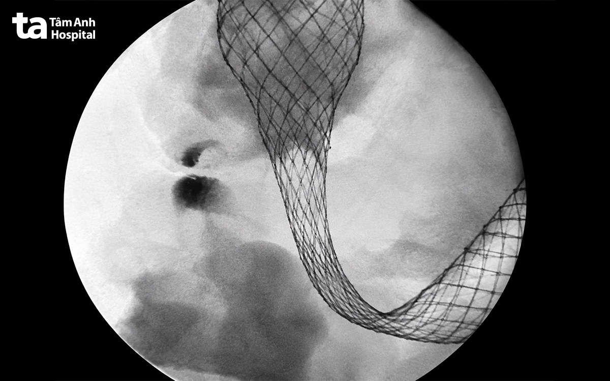 đặt stent kim loại cho đại tràng
