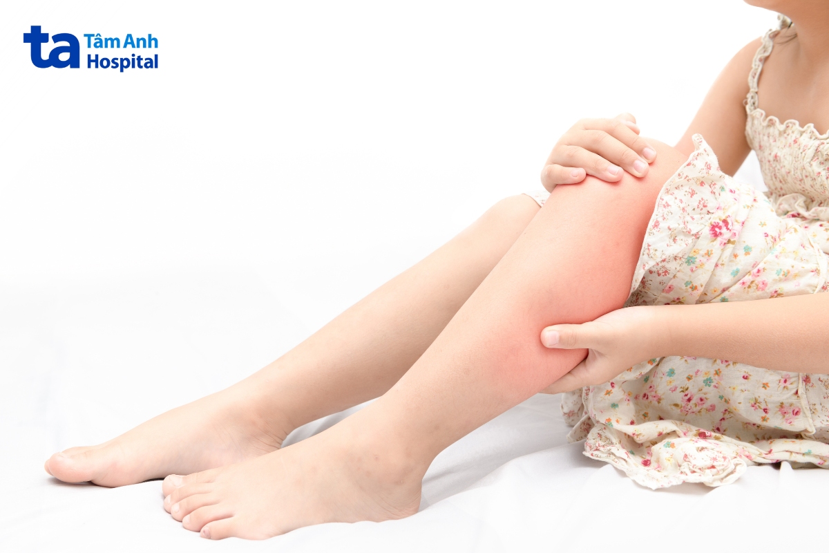 đau bắp chân sau sốt ở trẻ có thể liên quan đến tình trạng viêm cơ thoáng qua