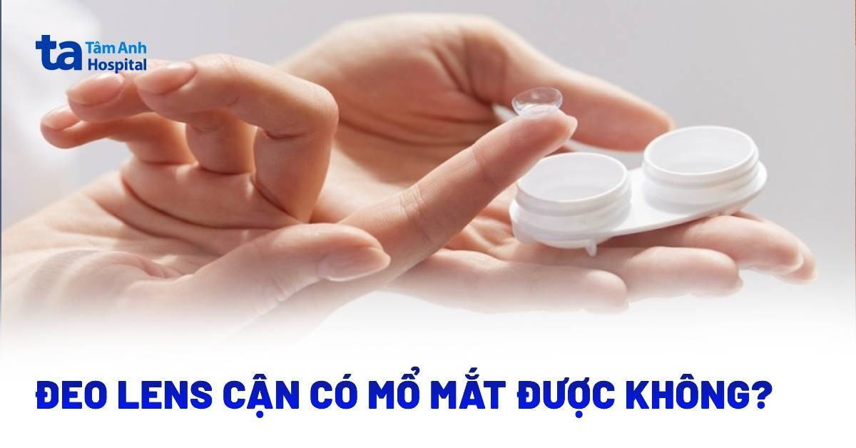 Đeo lens cận có mổ mắt được không? Thời gian ngừng đeo và lưu ý