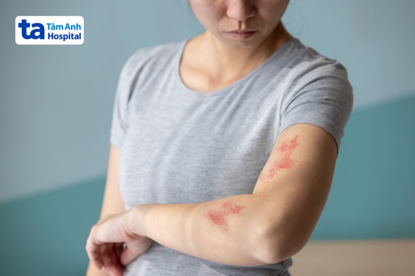 dị ứng thuốc sinh học chữa viêm khớp dạng thấp