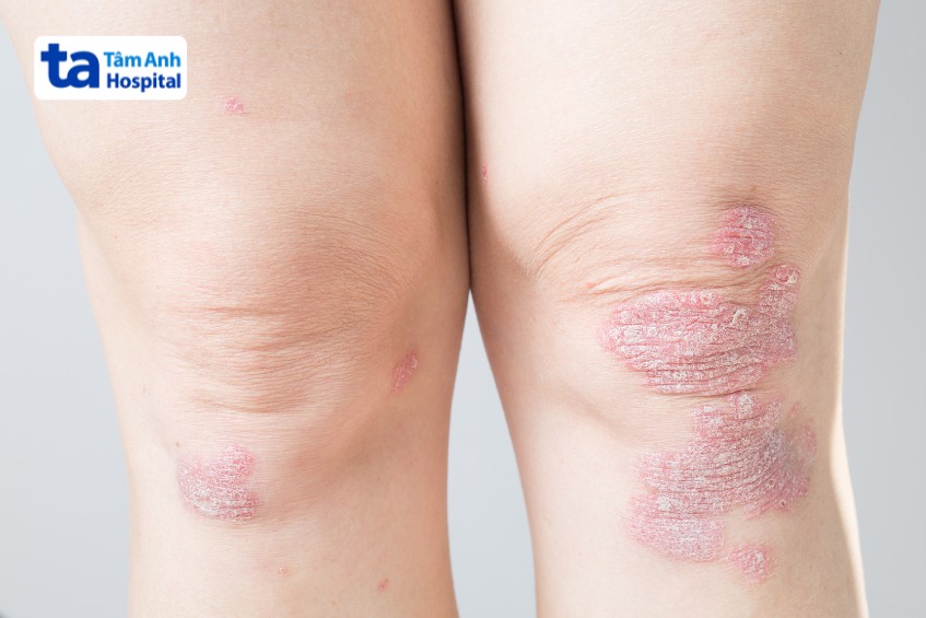dmards thuốc chống thấp khớp tác dụng chậm