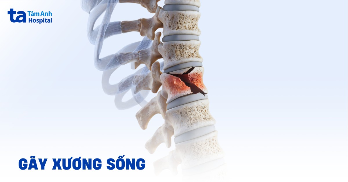 Gãy xương sống là gì? Dấu hiệu nhận biết và cách điều trị