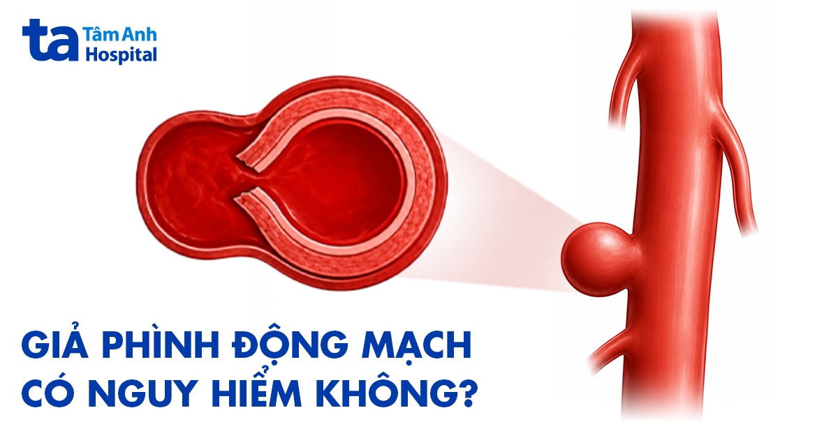 Giả phình động mạch: Giải đáp cụ thể