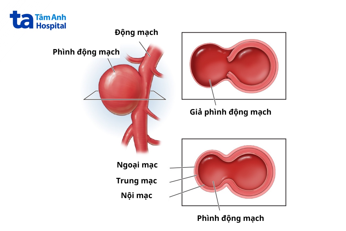 giả phình mạch