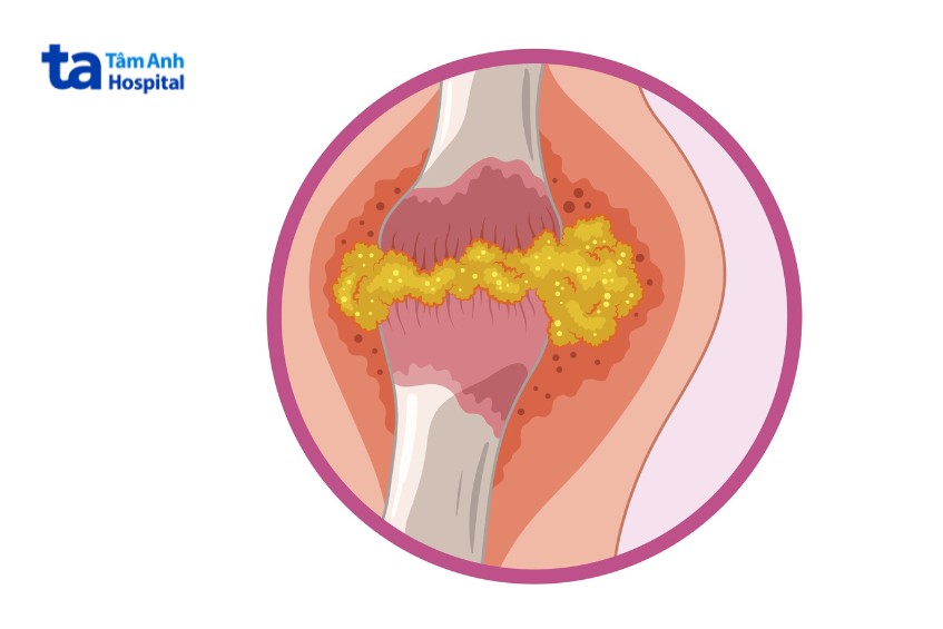 gout và viêm khớp dạng thấp