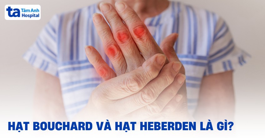 Hạt Bouchard và hạt Heberden: Cơ chế hình thành và tác động