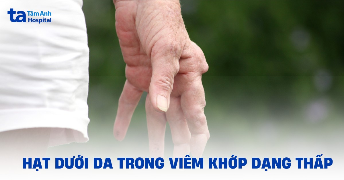 Nốt thấp khớp, hạt dưới da trong viêm khớp dạng thấp là gì?