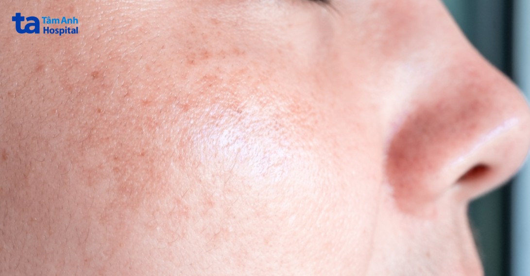 Hình Ảnh Da Nhiễm Corticoid Độ 1