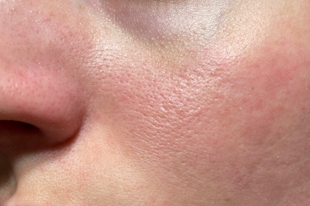 Hình Ảnh Da Nhiễm Corticoid Độ 2