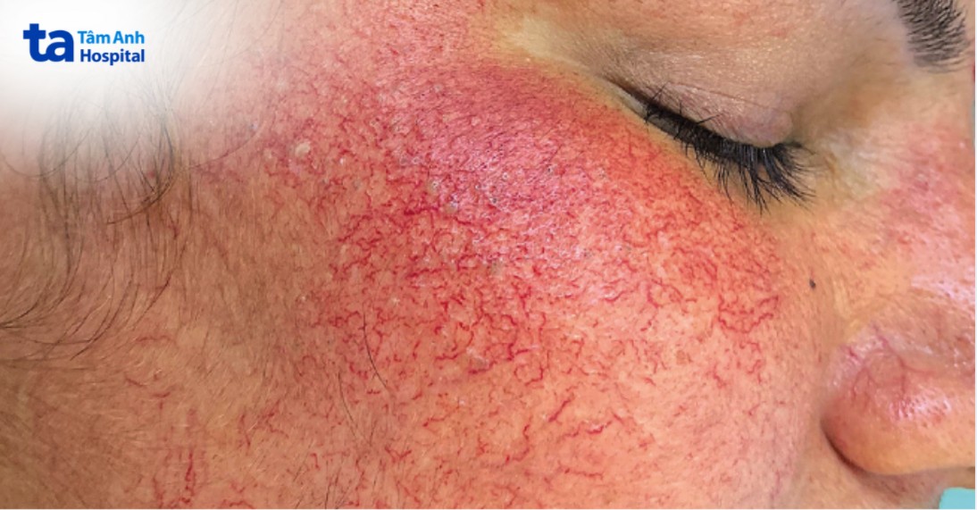 Hình Ảnh Da Nhiễm Corticoid Độ 5