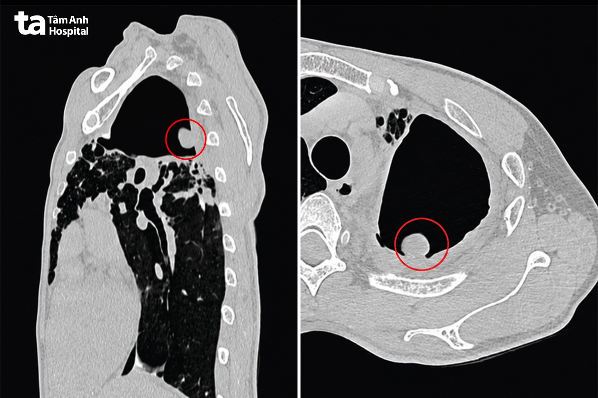 hình ảnh khối u nấm phổi xuất hiện trên hình ct scan