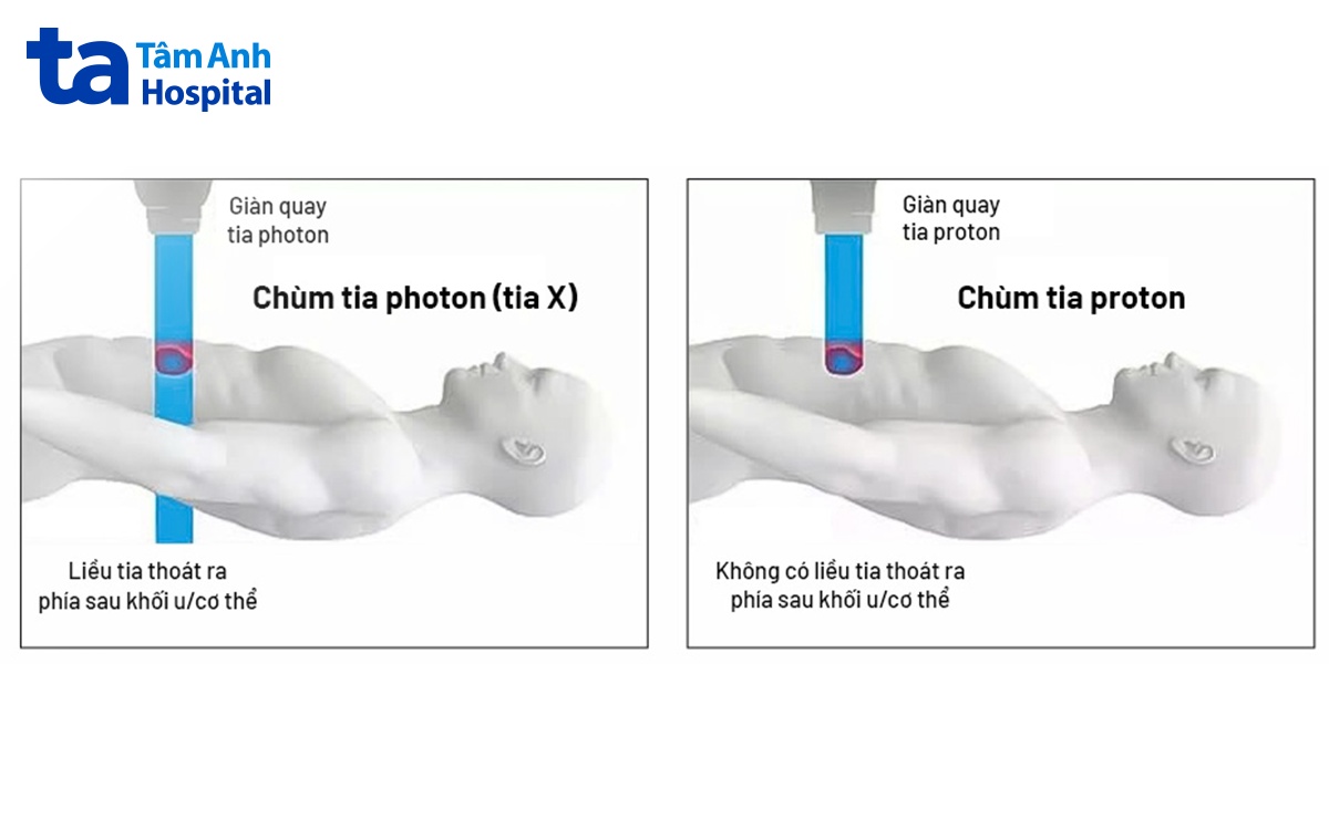 hình ảnh minh họa xạ trị