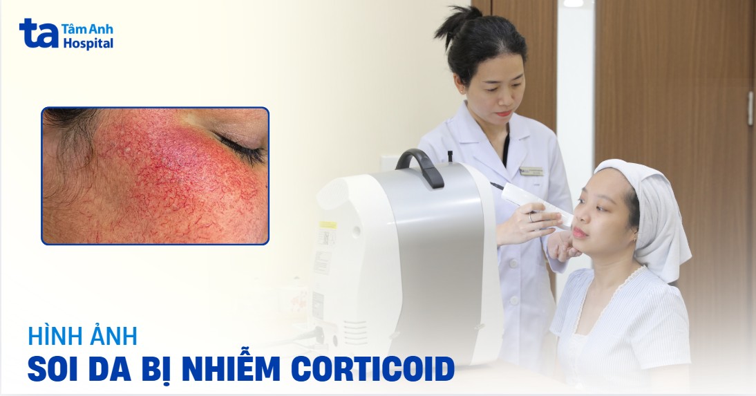 Nhận biết hình ảnh soi da bị nhiễm corticoid