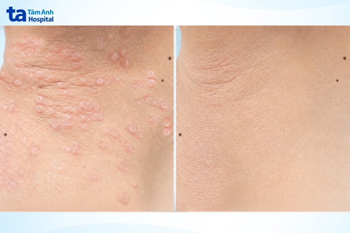 hình ảnh vết thương sau 3 tháng điều trị