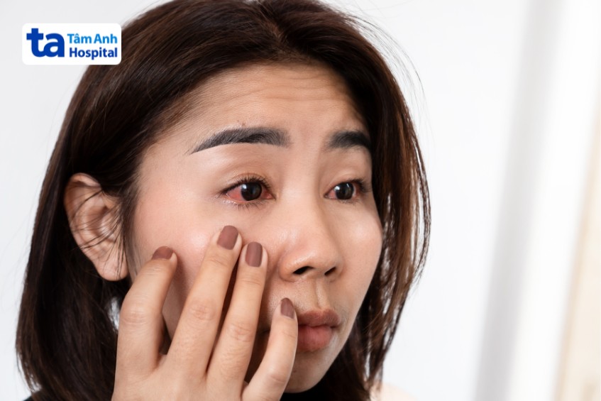 hình ảnh viêm khớp dạng thấp​ ảnh hưởng mắt