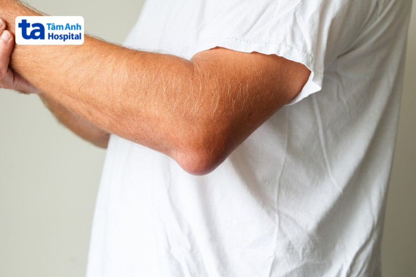 hình ảnh viêm khớp dạng thấp​ gây nóng đỏ khủy tay