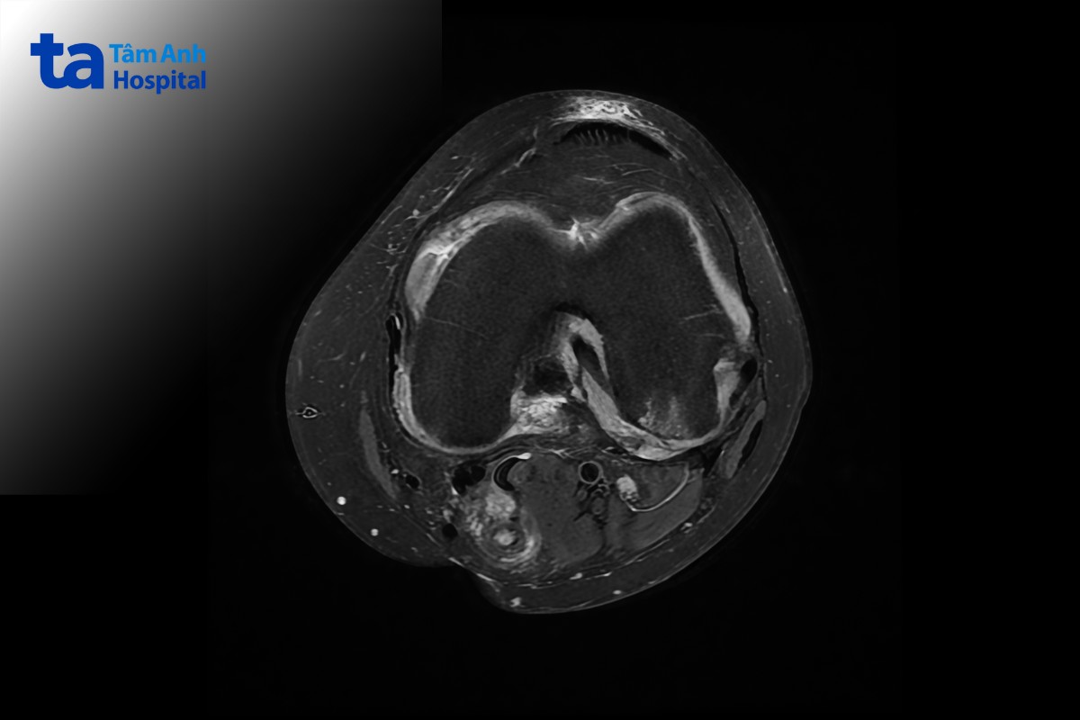 hình ảnh viêm khớp dạng thấp ở gối trên mri