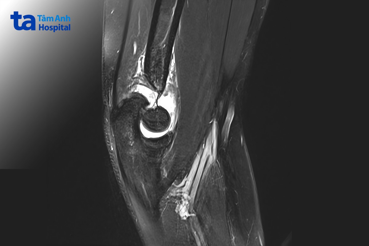 hình ảnh viêm khớp dạng thấp ở khủy tay trên mri
