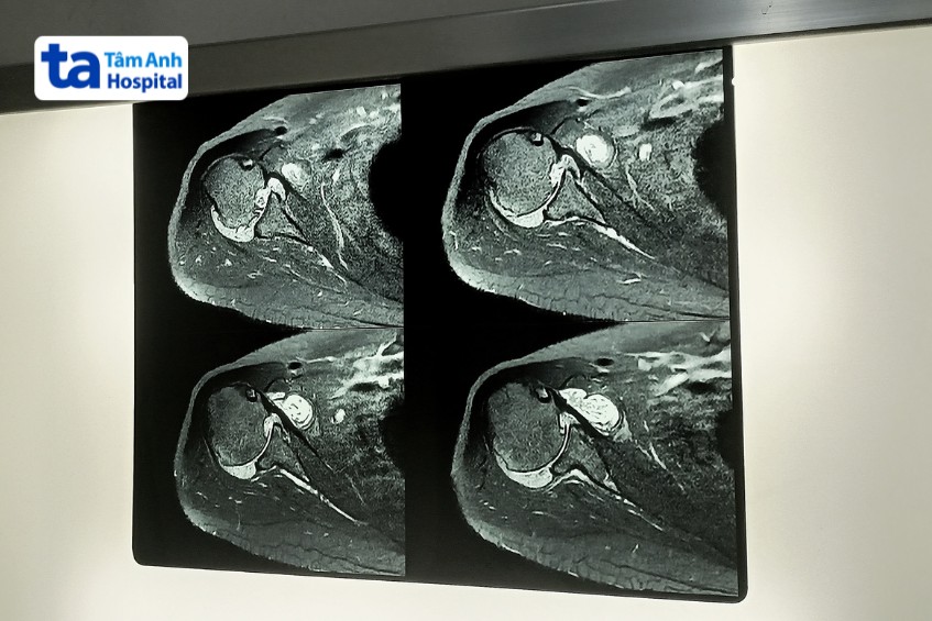 hình ảnh viêm khớp dạng thấp ở vai trên mri