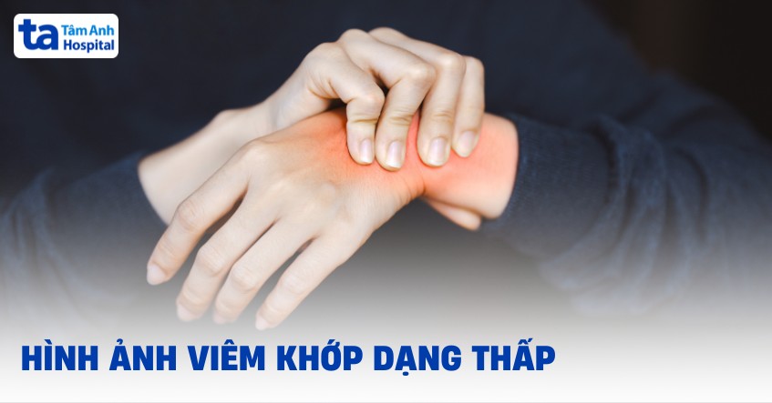 Hình ảnh viêm khớp dạng thấp trên X quang tại các vị trí cơ thể