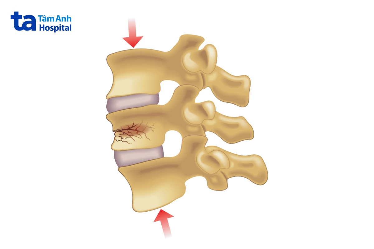 hình ảnh xẹp đốt sống