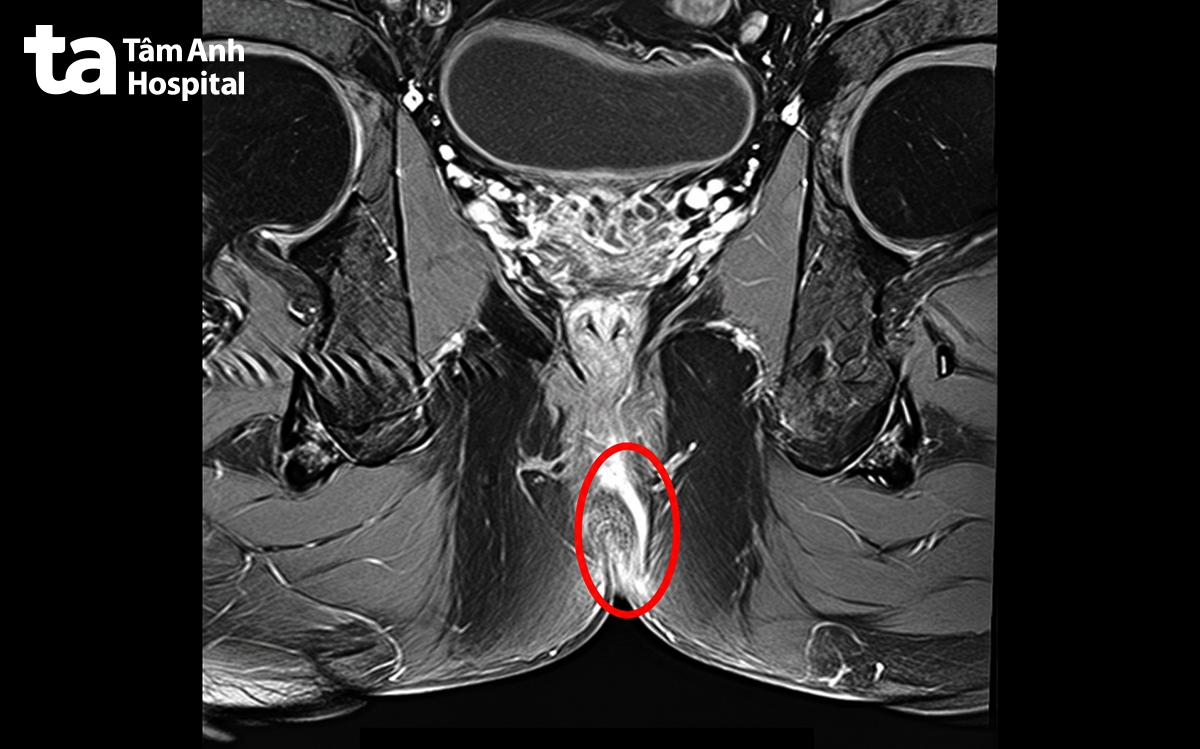 hình chụp mri đường rò hậu môn