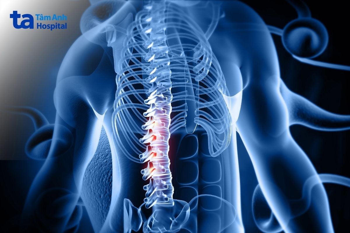 hình chụp thoái hóa cột sống lưng