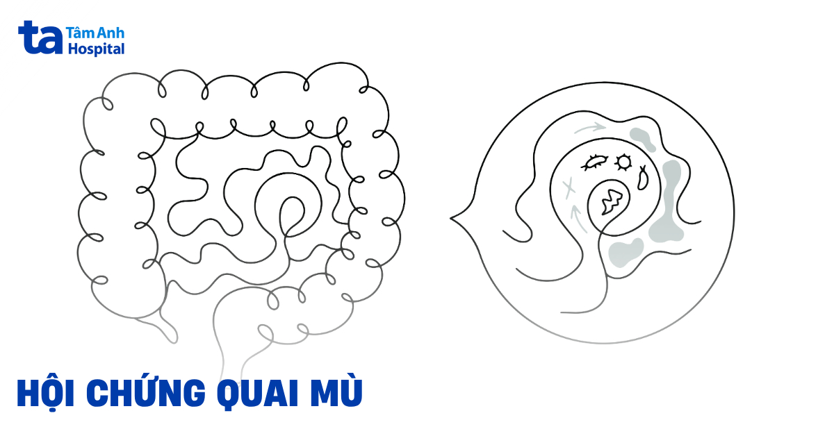 Tìm hiểu hội chứng quai mù ở ruột non