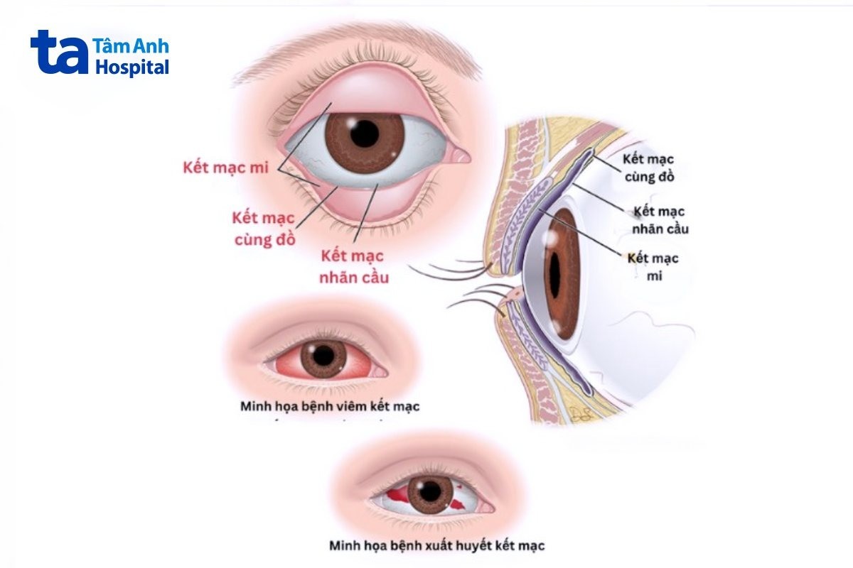 kết mạc là gì