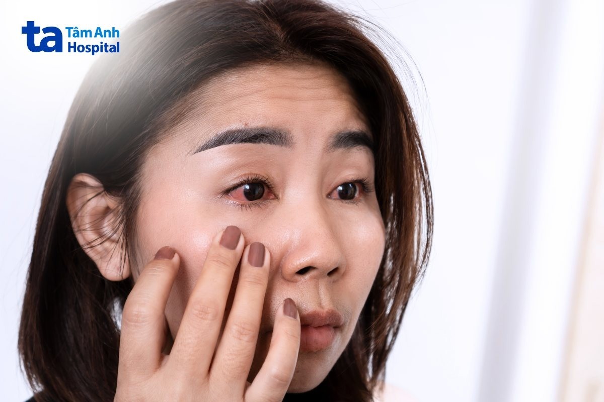 kết mạc mắt