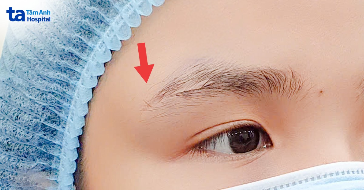 khối u nhô rõ trên mi mắt phải của bệnh nhân