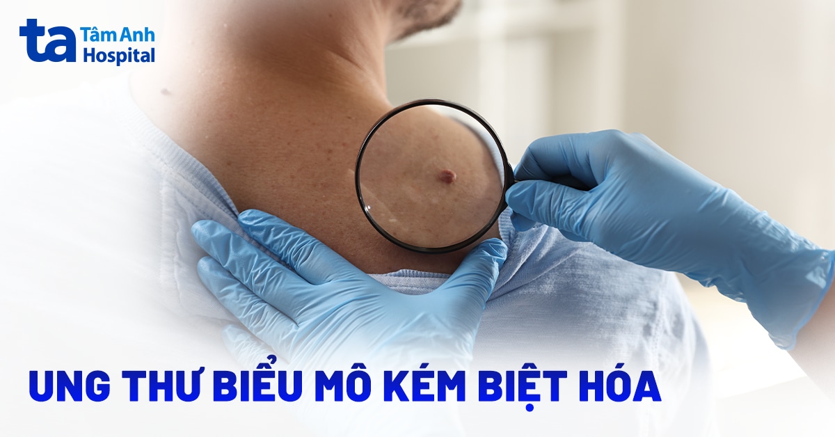 Ung thư biểu mô kém biệt hóa là gì? Hướng điều trị hiện nay