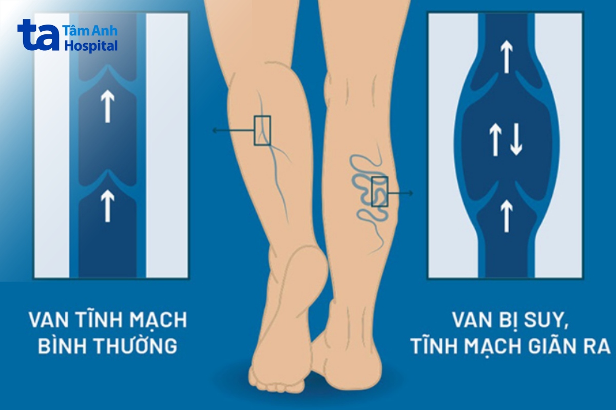 Loét Động Mạch
