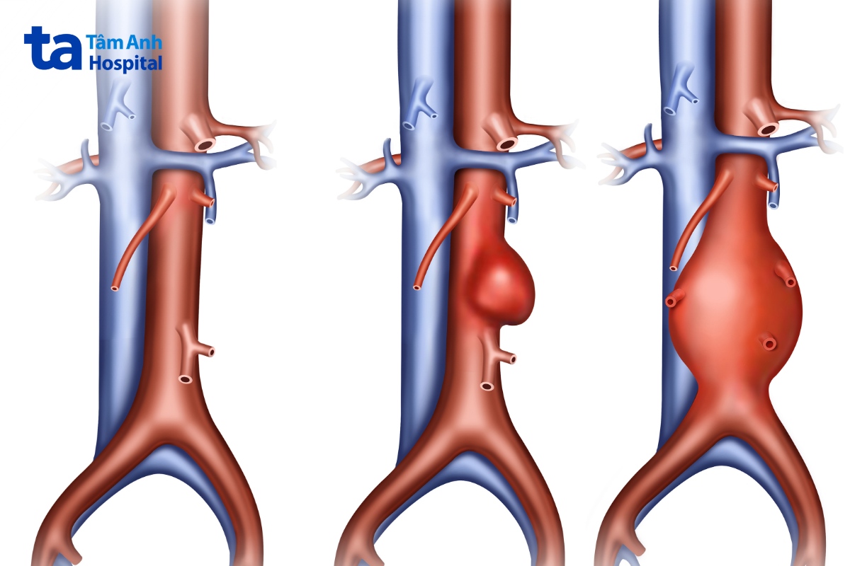 loét động mạch chủ xuyên thấu có nguy hiểm không