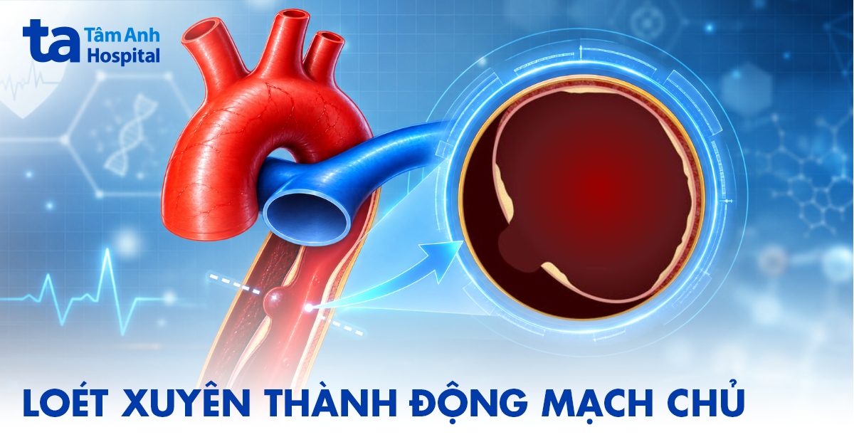 Loét động mạch chủ xuyên thấu và các giải pháp
