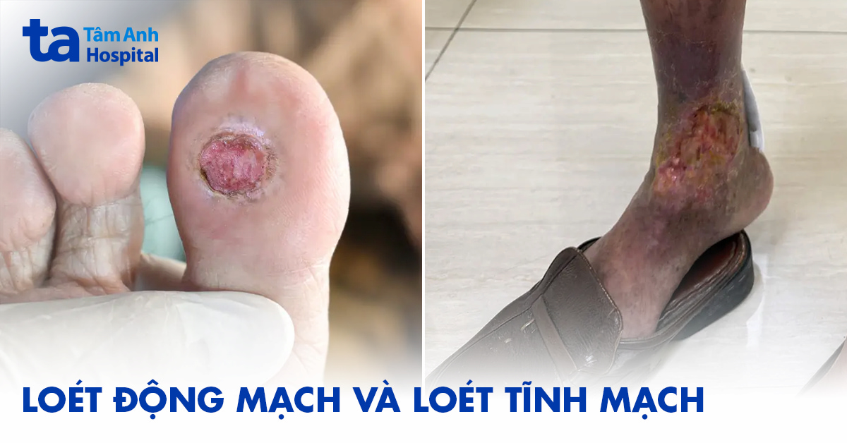Loét Động Mạch Và Loét Tĩnh Mạch
