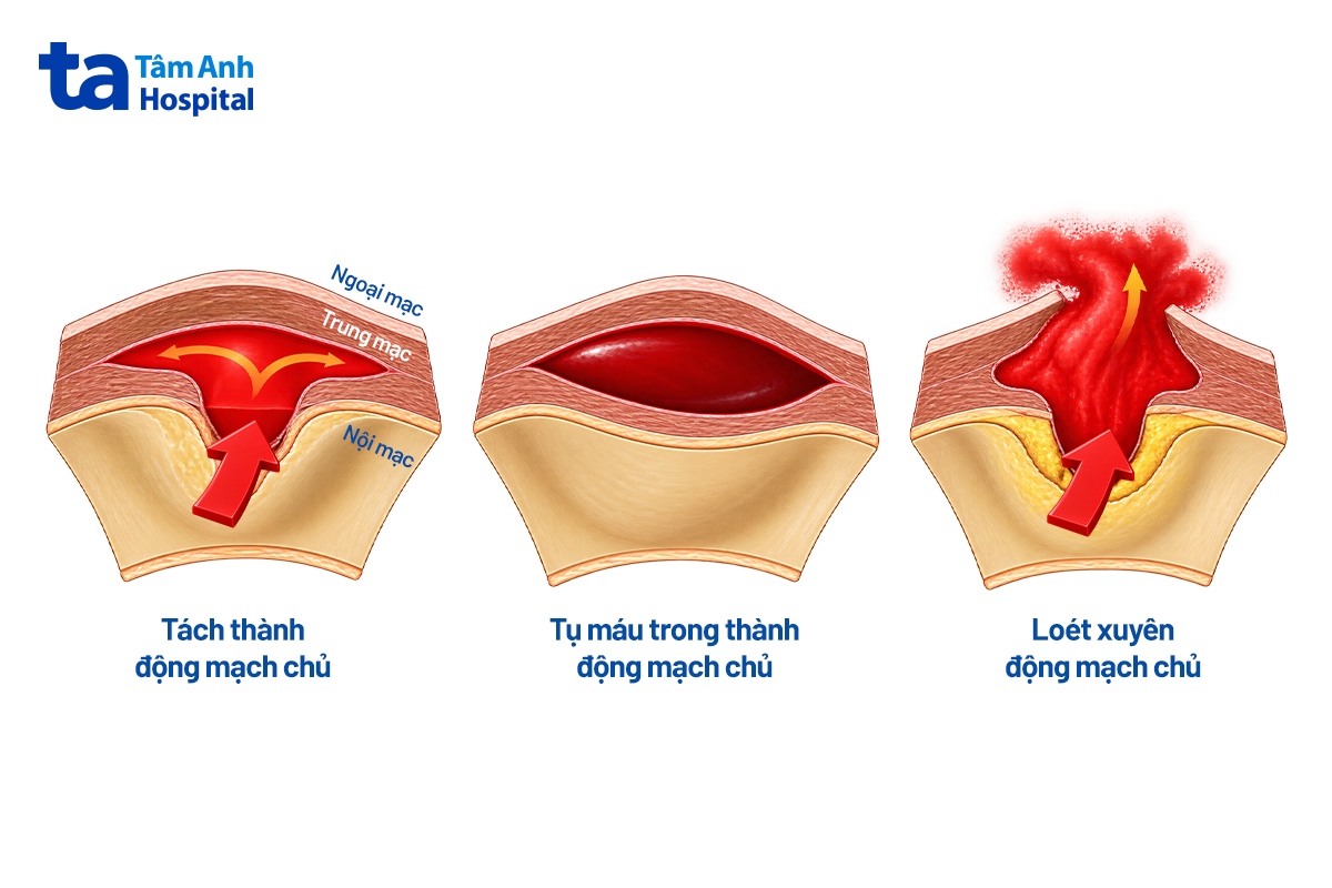 loét động mạch
