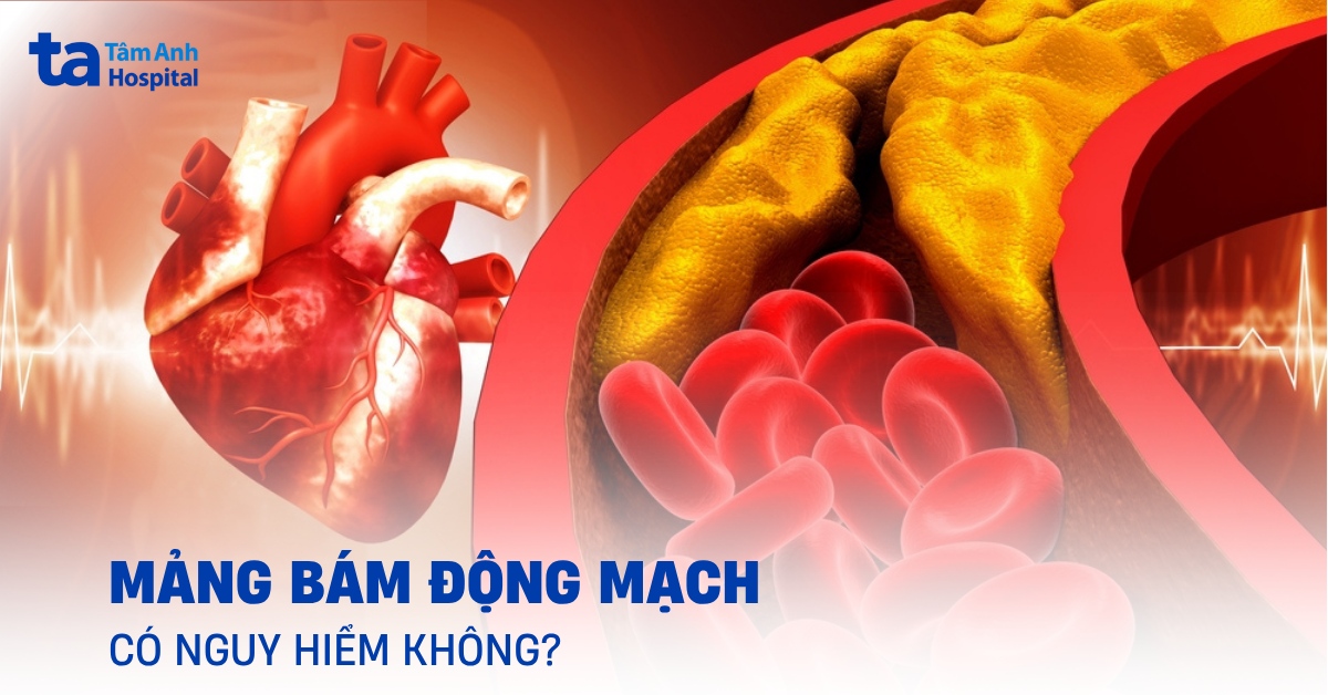 Mảng bám động mạch hình thành do đâu? Có đáng ngại?