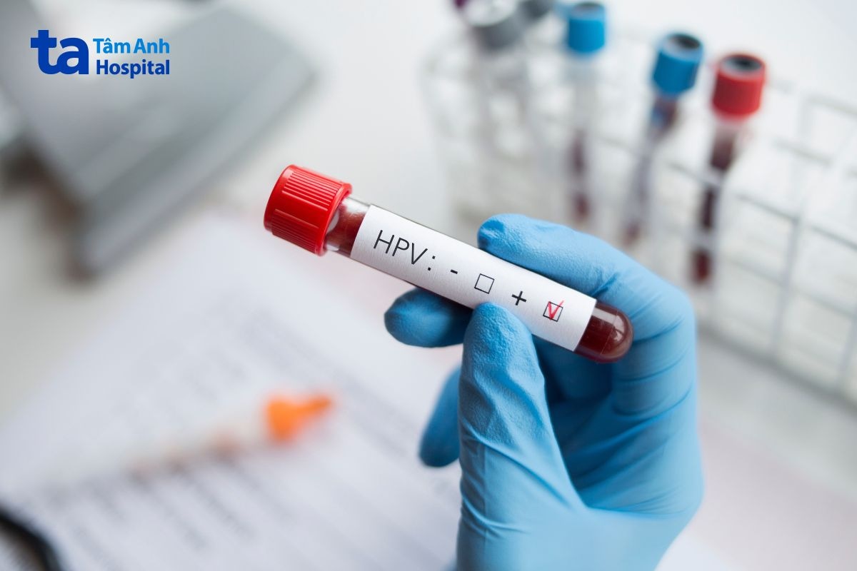 Nhân viên y tế cầm ống mẫu xét nghiệm HPV dương tính.