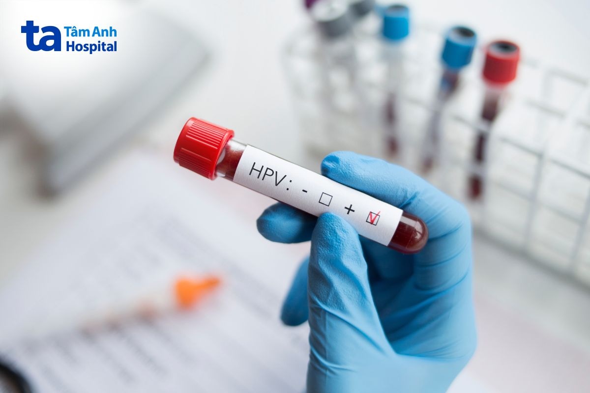 Ống mẫu xét nghiệm HPV cho kết quả dương tính