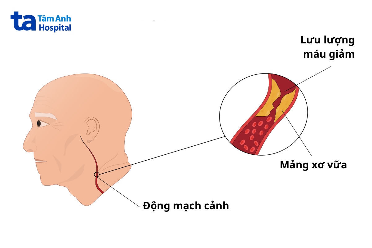 mổ động mạch cảnh