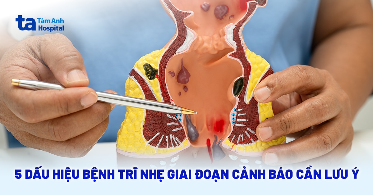 5 dấu hiệu bệnh trĩ nhẹ giai đoạn đầu cảnh báo cần lưu ý