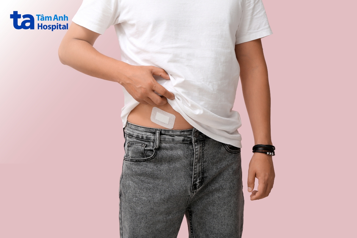 mổ ruột thừa có vết thương nhỏ