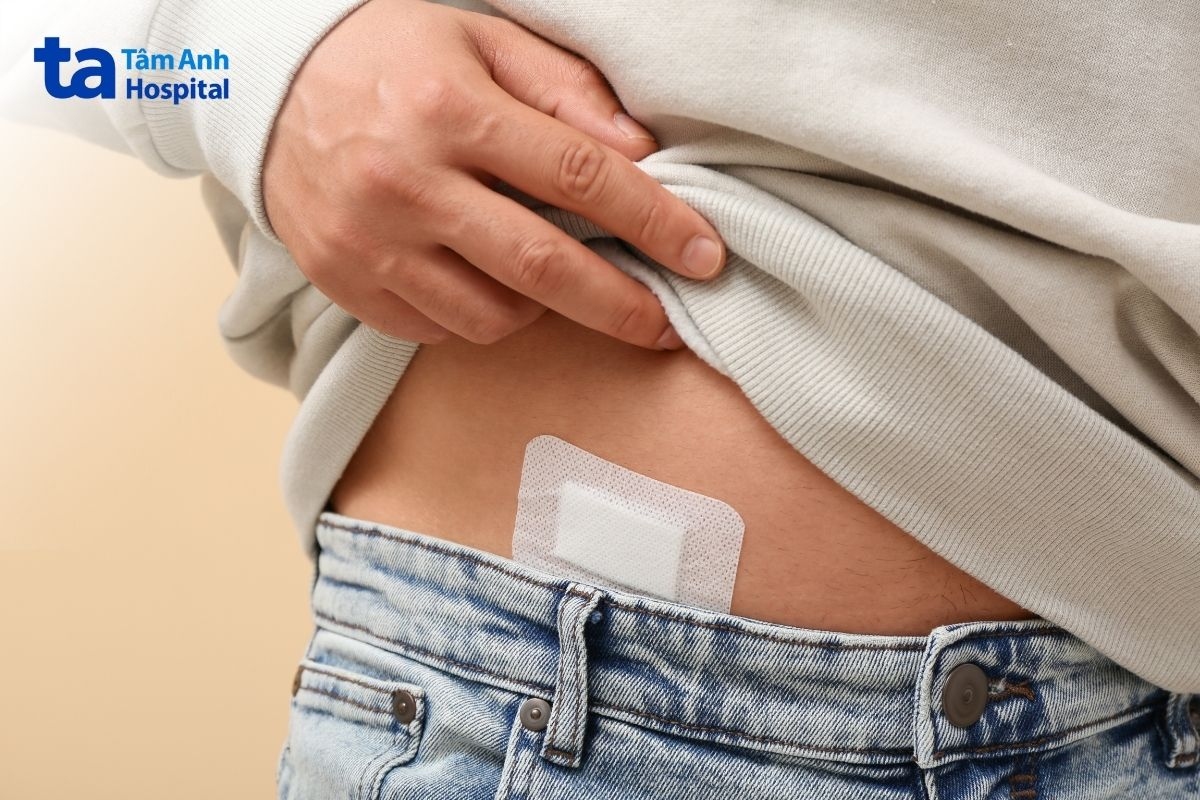 mổ ruột thừa có vết thương