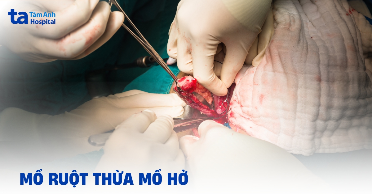 Mổ ruột thừa mổ hở: Quy trình và thời gian hồi phục