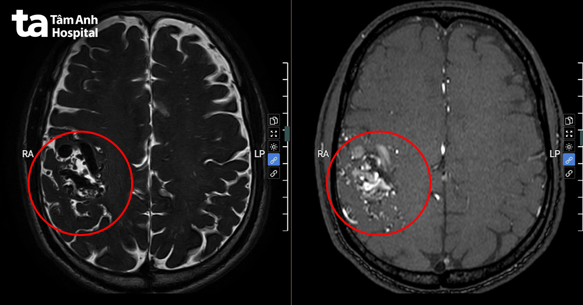 MRI cho thấy ổ dị dạng mạch máu