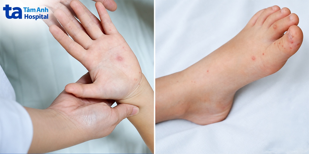 mụn nước xuất hiện ở trẻ mắc tay chân miệng