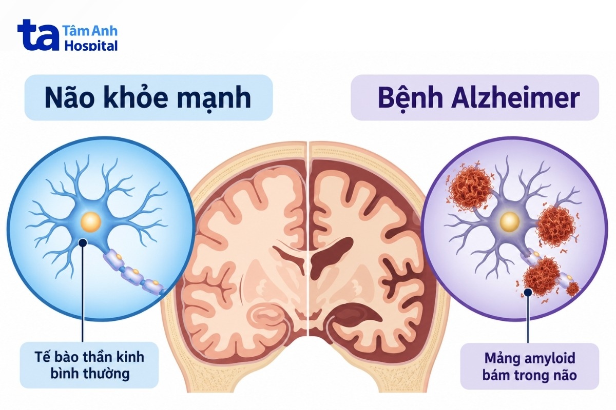 ngày bệnh alzheimer thế giới
