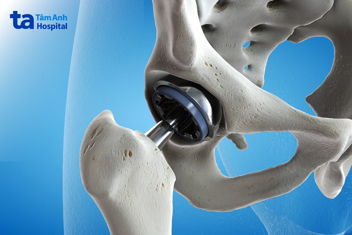 người bị viêm cột sống dính khớp sống được bao lâu
