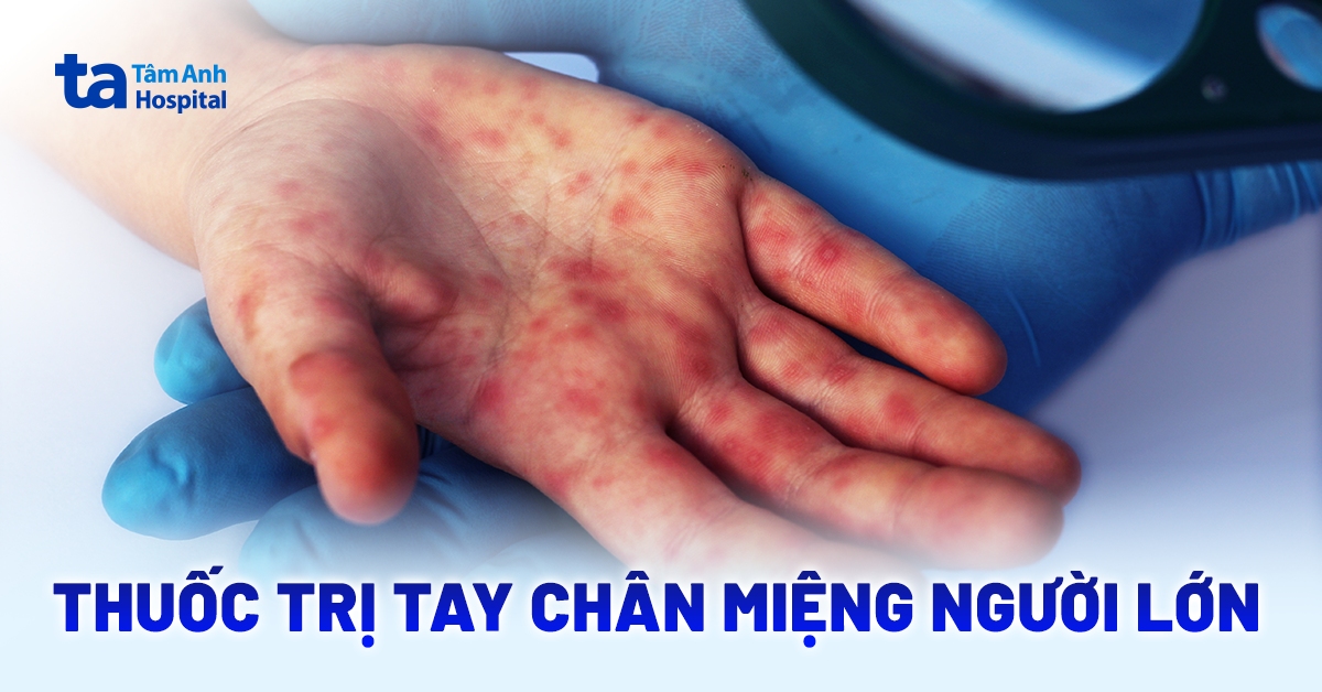 Người lớn bị tay chân miệng uống thuốc gì cho đúng?